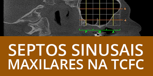 Prevalência de septos sinusais maxilares em pacientes parcial e totalmente desdentados, baseada em 150 exames de tomografias feixe cônico (TCFC)