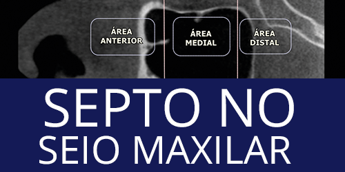Análise volumétrica do septo no seio maxilar exibida por tomografia computadorizada feixe cônico na população peruana – estudo retrospectivo transversal