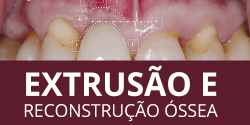 Extrusão ortodôntica de dentes condenados para reconstrução da arquitetura óssea tridimensional previamente à instalação de implantes osseointegrados – Análise crítica da literatura