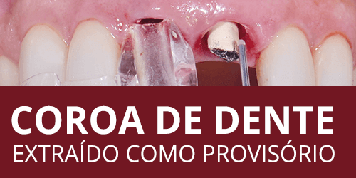 Substituição dentária conservadora utilizando implantes e o dente pré-existente para provisórios estéticos